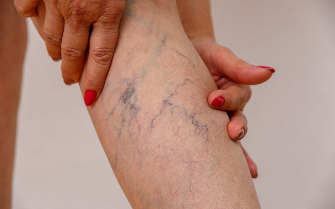 You must consider 8 crucial factors when looking for the best vein doctor near Great Neck. This article helps you find the best vein doctors near your location.