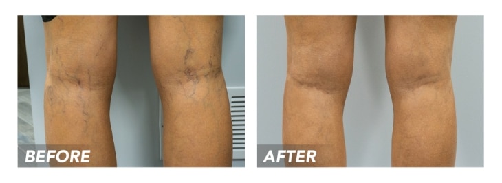 Clip Vein Treatment Clinic is the best state-of-the-art vein clinic near Bethpage, Long Island. This article describes our vein clinic’s characteristics and provides a detailed guideline to our vein treatments.