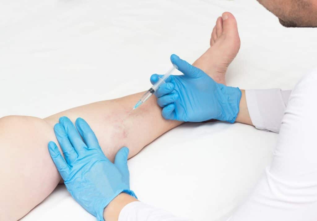 Are you wondering, “do spider veins go away?” The answer is no, they don’t. We discuss the root cause and treatment of spider veins and the vein centers in Long Island.