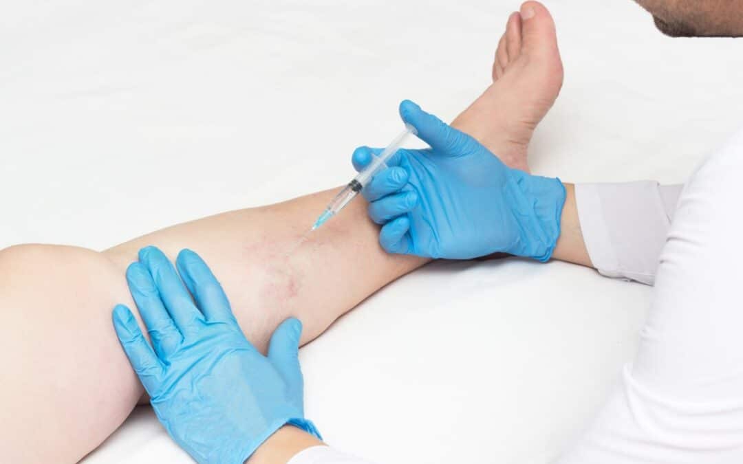 Is it worth getting varicose veins removed? What happens if varicose veins are left untreated? We answer your questions about minimally invasive varicose vein treatments.