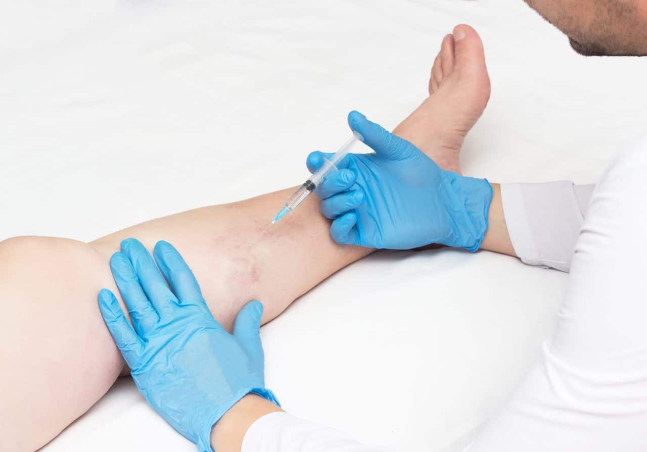 What happens if spider veins are left untreated? Learn the consequences of leaving spider veins untreated. Long Island Vein Center explains the risks, symptoms, and treatments.